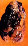 Pulmón con Enfisema.jpg