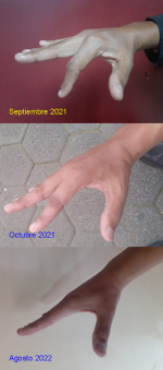 Dedo tullido.png