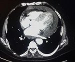 Efusion pericardial.jpg