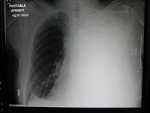 Efusion Pleural.jpg