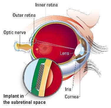 artificial-vision3.jpg