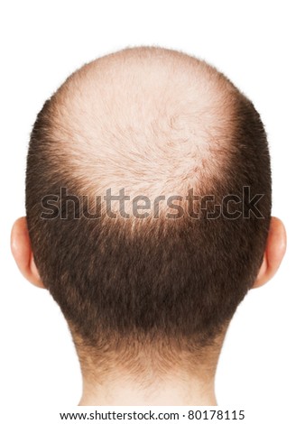 stock-photo-human-alopecia-or-hair-loss-adult-men-bald-head-80178115.jpg