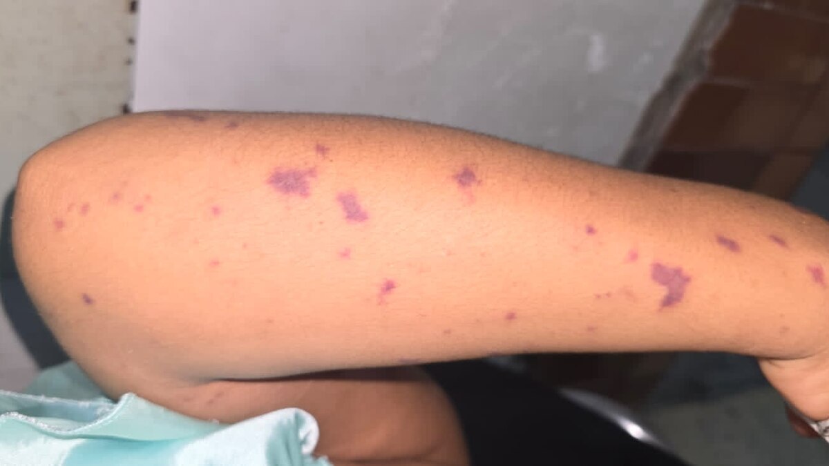 Vacunación ante brote por meningococo en Loreto: ¿es crucial para el control de la infección? Vacunación ante brote por meningococo en Loreto: ¿es crucial para el control de la infección?